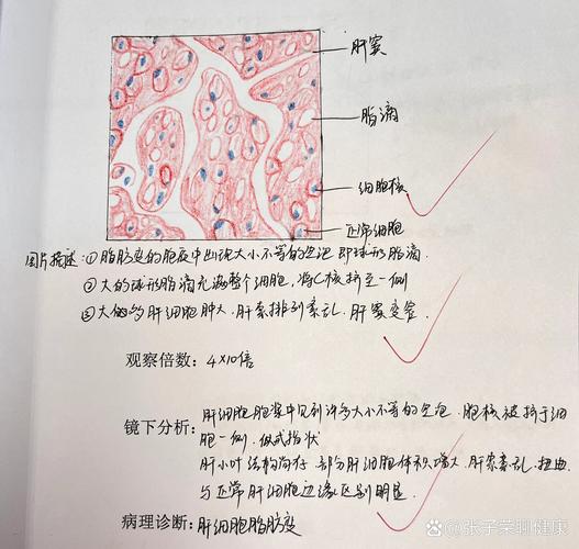 肝脂肪变性如何诊断与治疗?-第1张图片-宁夏农业信息网 肝脂肪变性如何诊断与治疗?-第1张图片-宁夏农业信息网
