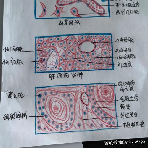 肝脂肪变性如何诊断与治疗？-第2张图片-宁夏农业信息网